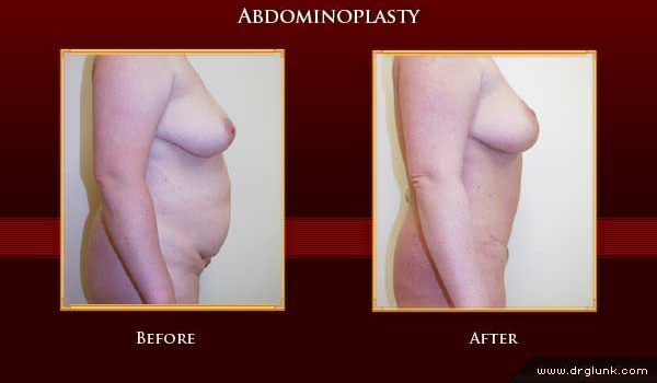 Before and After Photo