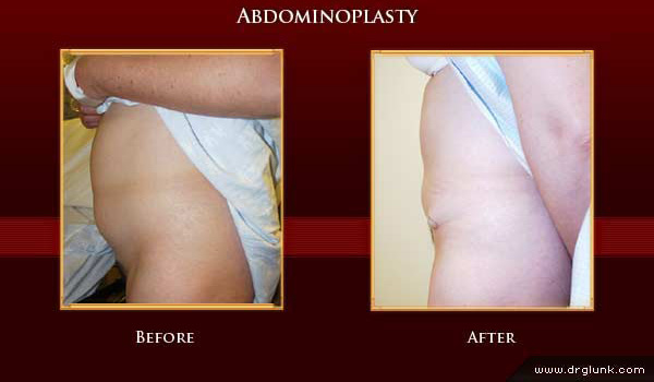 Before and After Photo