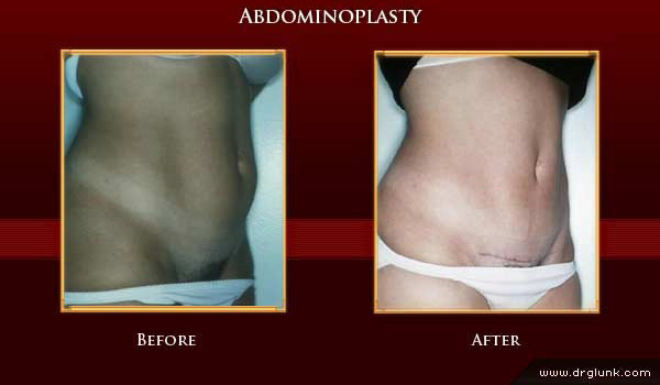 Before and After Photo