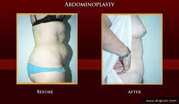Before and After Photo