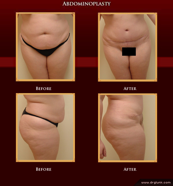 Before and After Photo