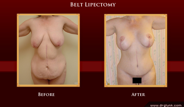 Before and After Photo