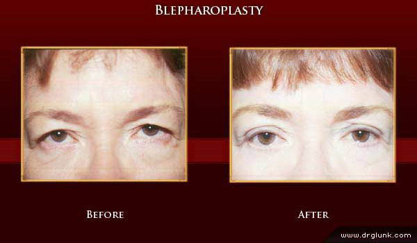 Before and After Photo