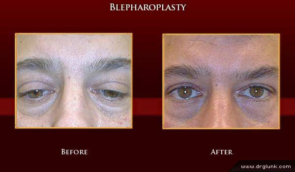 Before and After Photo