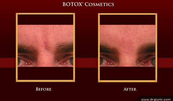 Before and After Photo