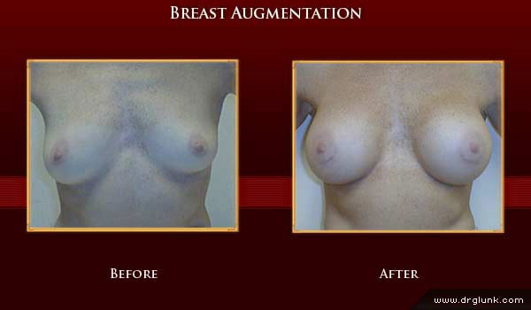 Before and After Photo