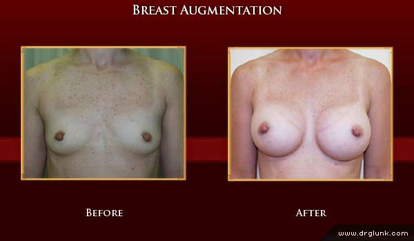 Before and After Photo