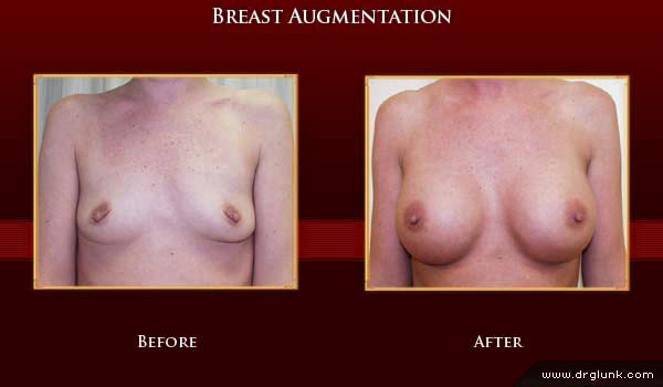 Before and After Photo