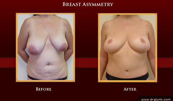 Before and After Photo