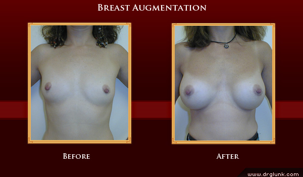 Before and After Photo
