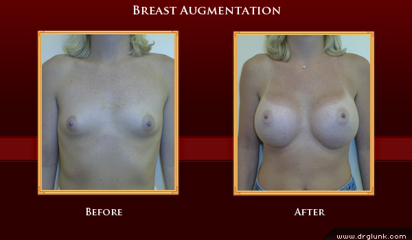 Before and After Photo