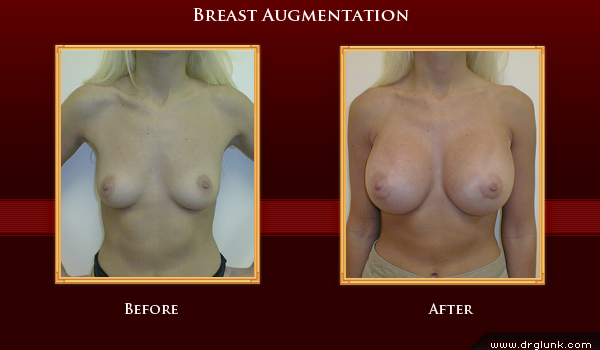 Before and After Photo
