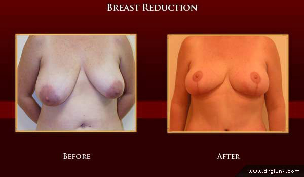 Before and After Photo