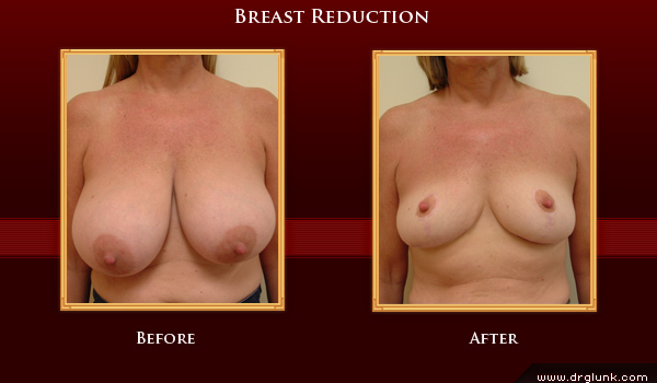 Before and After Photo