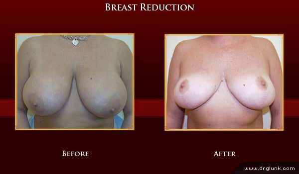 Before and After Photo