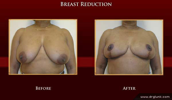 Before and After Photo