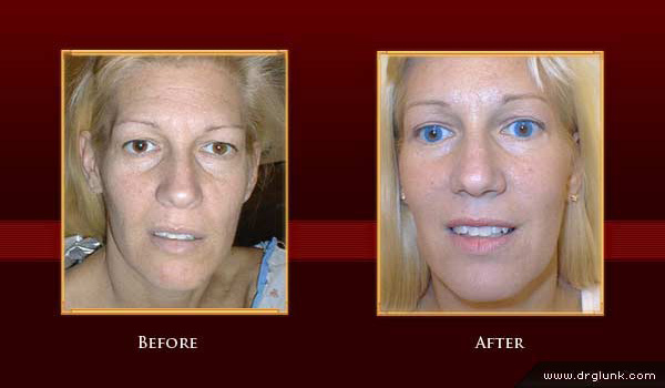 Before and After Photo