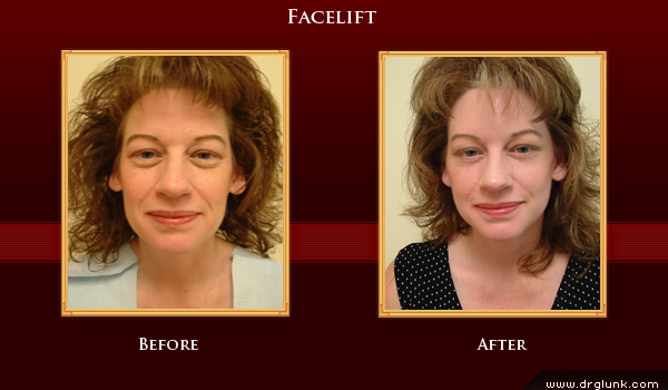 Before and After Photo