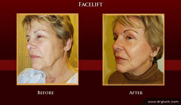 Before and After Photo