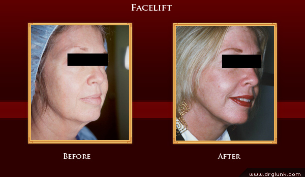 Before and After Photo