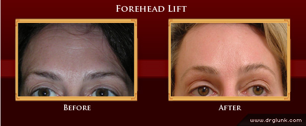 Before and After Photo