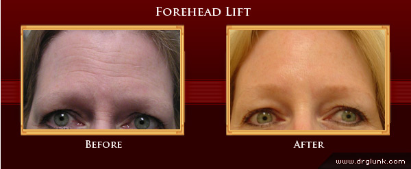 Before and After Photo