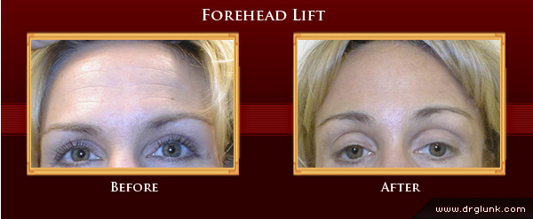 Before and After Photo