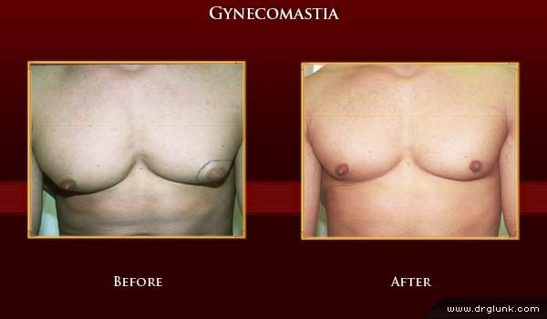 Before and After Photo