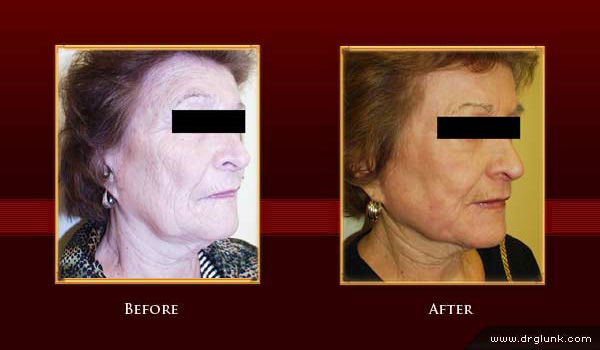 Before and After Photo