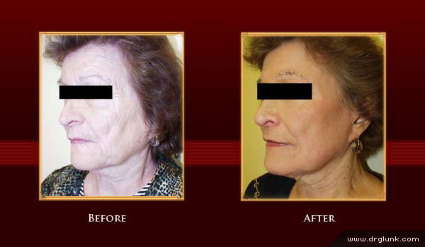 Before and After Photo