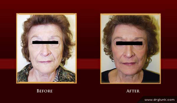 Before and After Photo