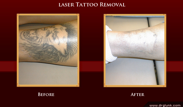 Before and After Photo