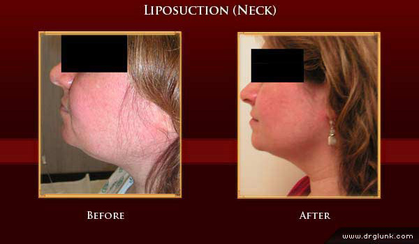 Before and After Photo
