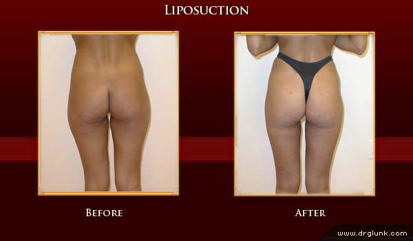 Before and After Photo