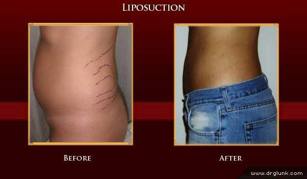 Before and After Photo