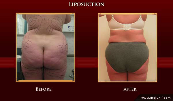 Before and After Photo