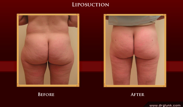 Before and After Photo