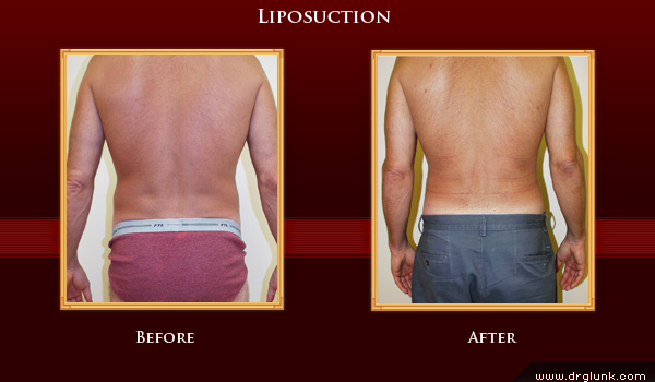Before and After Photo
