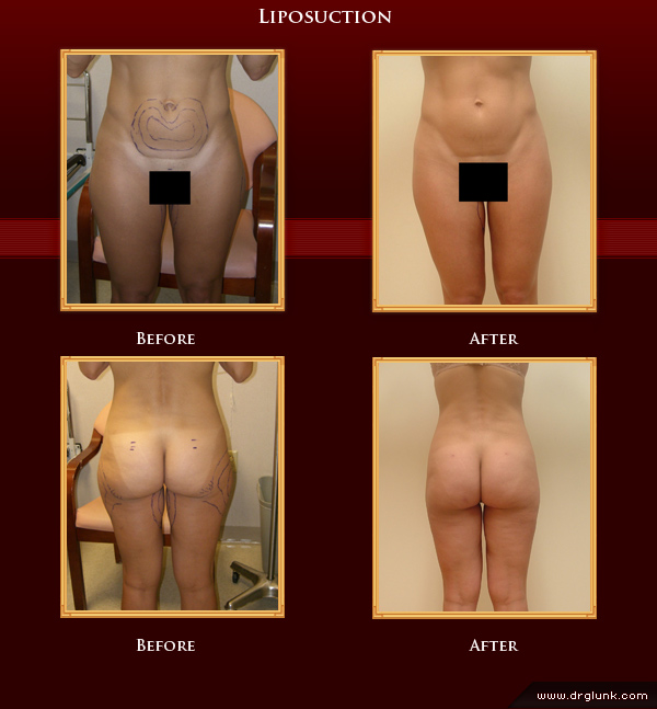 Before and After Photo