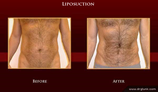 Before and After Photo