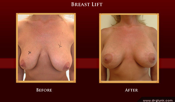 Before and After Photo