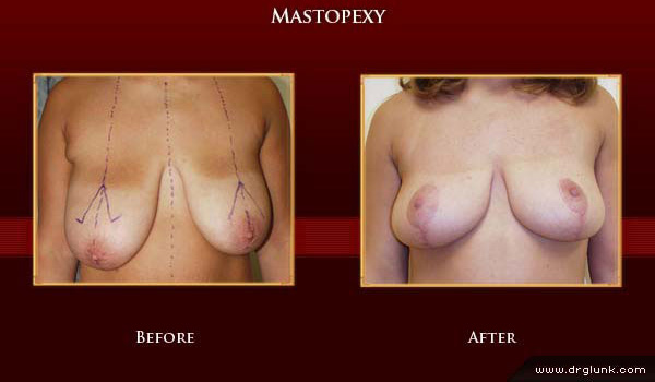 Before and After Photo