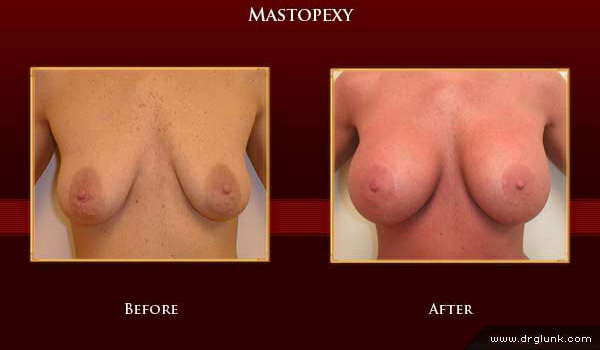 Before and After Photo
