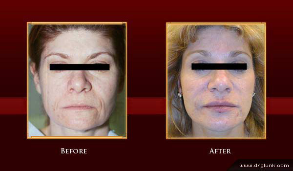 Before and After Photo