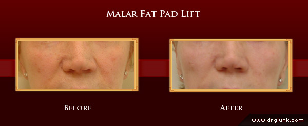Before and After Photo