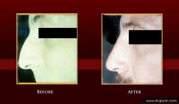 Before and After Photo