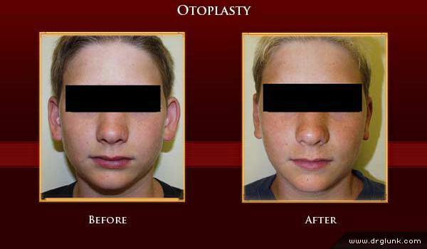 Before and After Photo