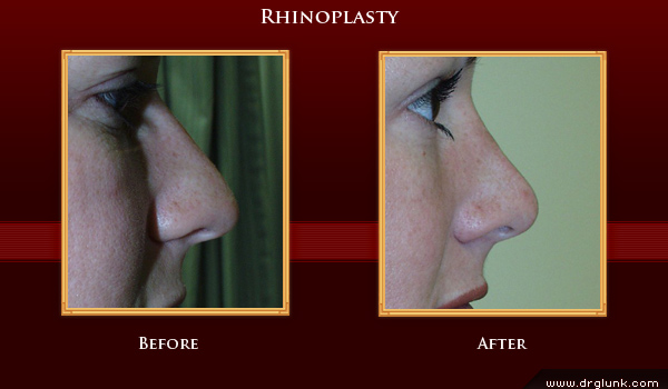 Before and After Photo