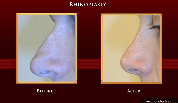 Before and After Photo