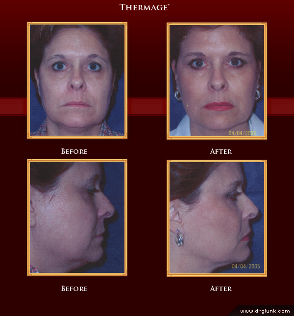 Before and After Photo